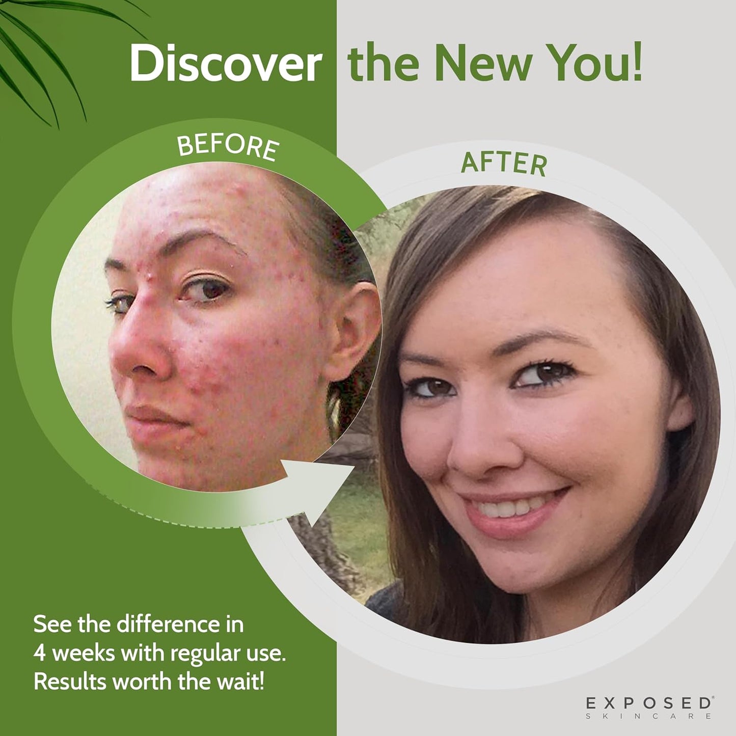 Exposed Skin Care, Acne Facial Cleanser with 0.5% Salicylic Acid for Sensitive and Acne-Prone Skin – Gentle Daily Face Wash for Breakout, Blackhead and Excess Oil – Natural, Non-toxic and Cruelty Free