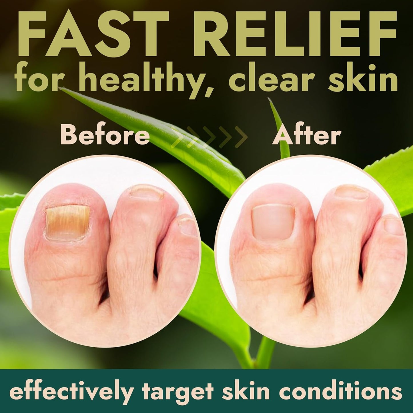 Nail Fungus Treatment Extra Strength for Toenail & Fingernails | Antifungal Nail Treatment with Tea Tree Oil | Fast-Acting, No-Touch Applicator | Restores Thickness & Discoloration | 20g