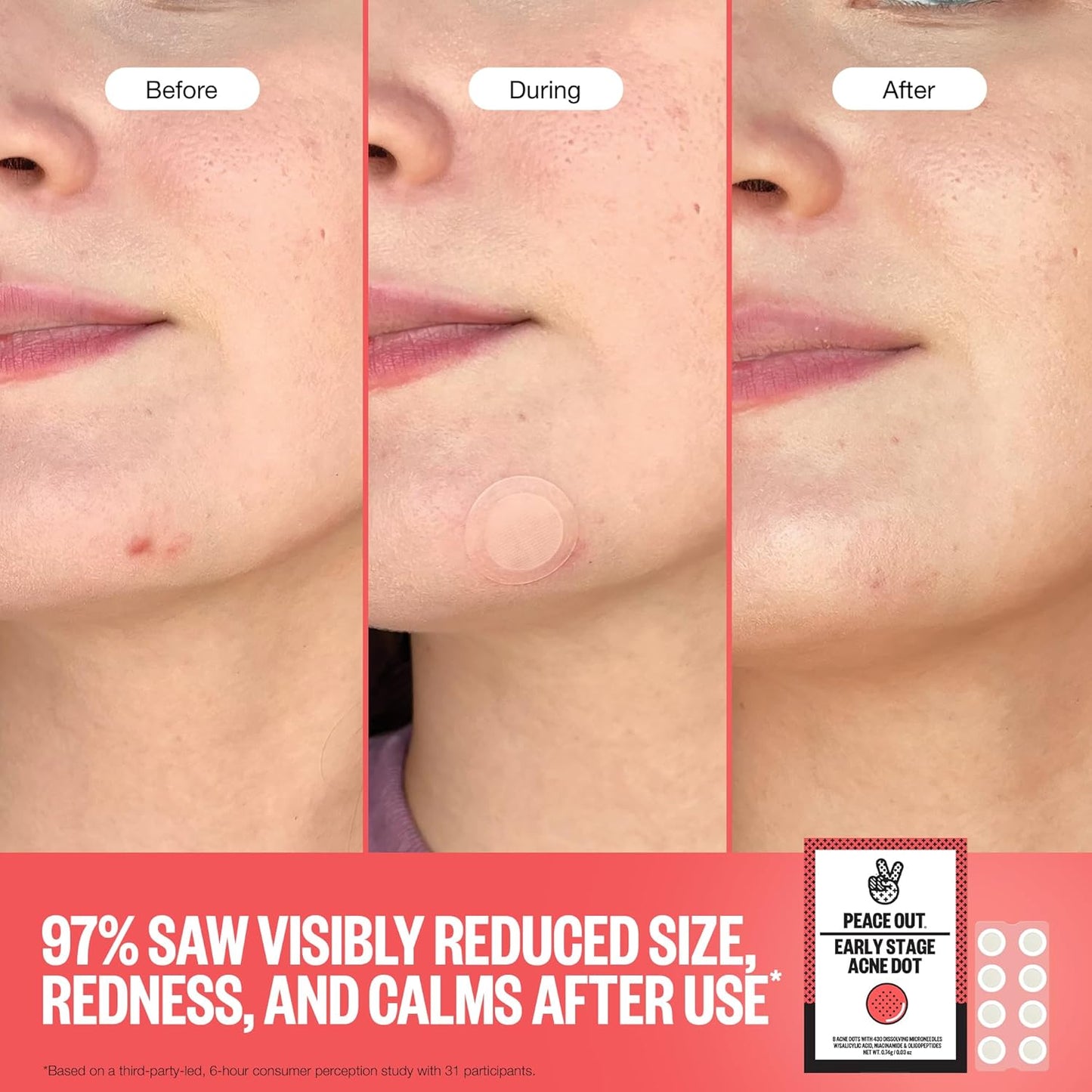PEACE OUT Early Stage Acne Dots Helps Target Blemishes Below the Surface, Hydrocolloid Pimple Patches Minimize Bumps Before They Appear with Dissolving Microneedles, Salicylic Acid, 8 Count