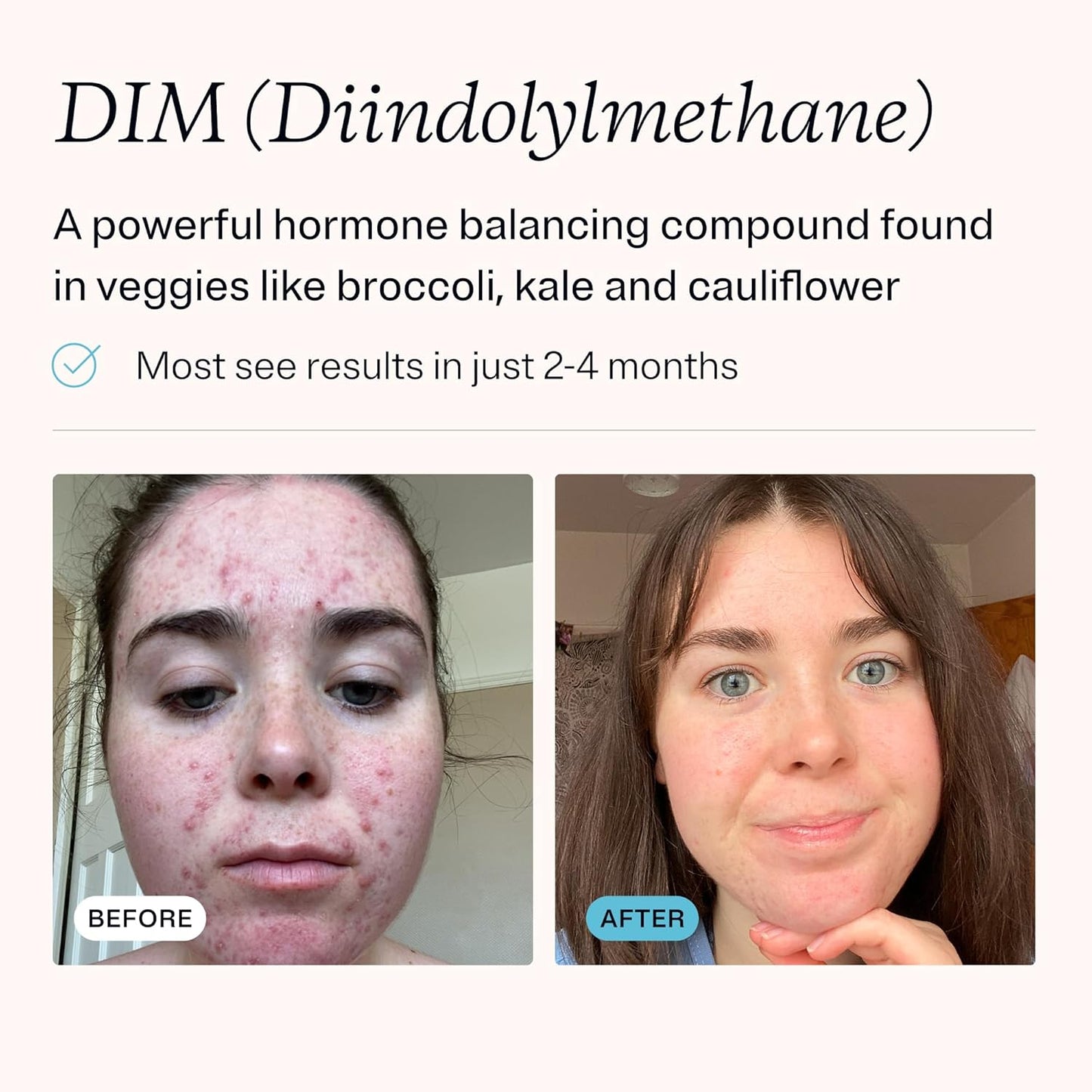 MDacne DIM Skin Clearing Supplements (90 Capsules) - for Acne Treatment, Estrogen Balance, Hormone Menopause Relief & Bodybuilding, Cruciferous Extract & Bioperine - Dermatologist Formulated (3 Pack)